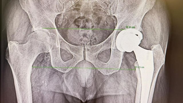 Pr&oacute;tesis de cadera