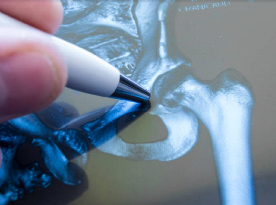 Protocolo de tratamiento quirúrgico precoz de las fracturas de cadera osteoporóticas