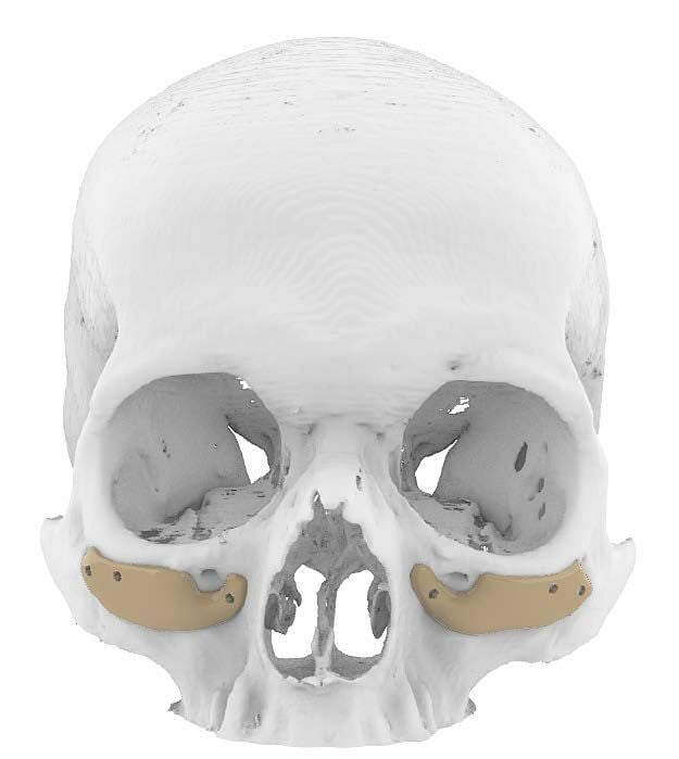 El Hospital Universitario La Luz dispone de un laboratorio digital 3D para planificar osteotomías de los huesos faciales y armonizar el rostro