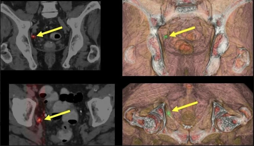 La imagen molecular avanzada y la radioterapia de precisión en el manejo del cáncer de próstata