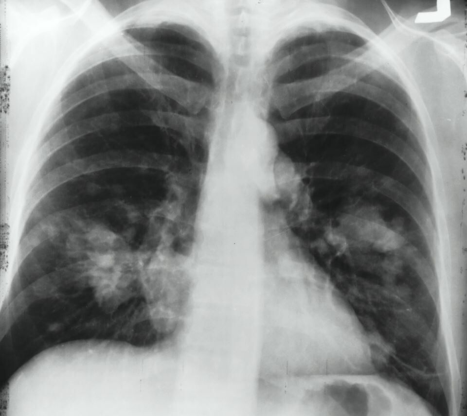 Un tercio de los pacientes diagnosticados de cáncer de pulmón tiene menos de 65 años
