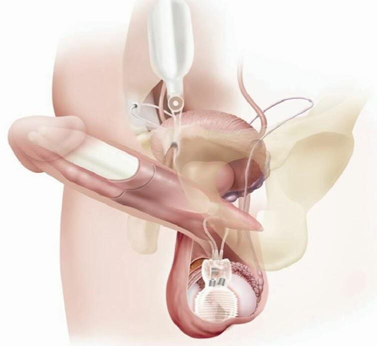 Las prótesis de pene pueden solucionar hasta el 90% de los casos complejos de disfunción eréctil en pacientes oncológicos