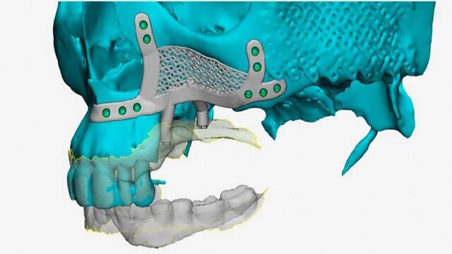 Reconstruir el hueso maxilar superior gracias a unos implantes dentales subperiósticos