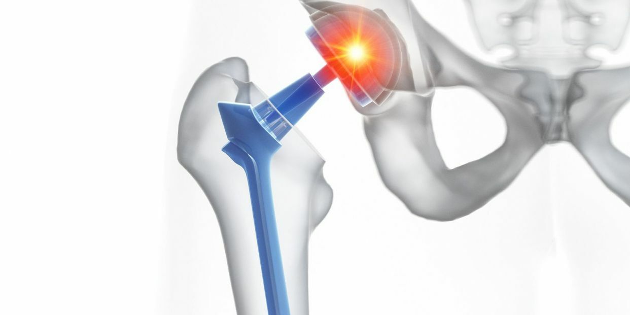 Prótesis de cadera a medida, una práctica cada vez más demandada: todas sus ventajas