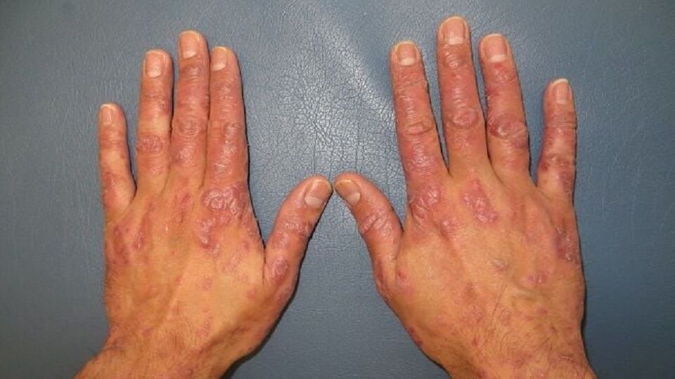 Artritis psoriásica, una enfermedad de las articulaciones que tiene 1 de cada 3 pacientes con psoriasis